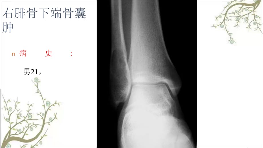 右腓骨下端骨囊肿优秀_第1页
